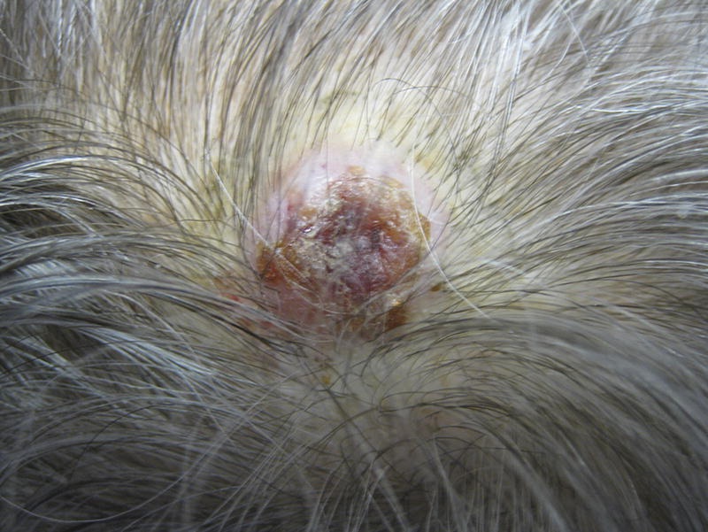 itchy scalp and rash on back of neck - Dermatology - MedHelp