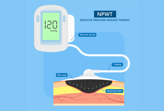 white christmas dresses Smith and Nephew 66022013 PICO 7 Single Use Negative Pressure Wound Therapy  System, NWPT, Wound Vac, 10 cm x 30 cm, One dressing – woundcareshop
