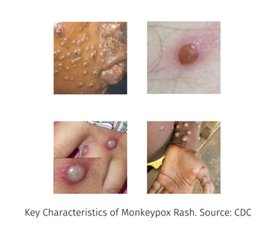 Characteristics-of-Monkeypox-Rash.png