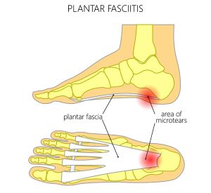 plantar-fasciitis-(1).jpg