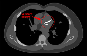 Heart-CT_CAC-score_300x195-(2).png