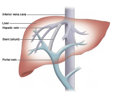 TIPS-Procedure-Image.jpg TIPS-Procedure-Image.jpg