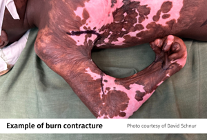 Burn-Contracture-1.png Burn-Contracture-1.png