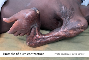 Burn-contracture-2.png