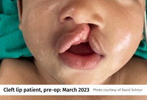 Cleft-Lip-Pre-Op.png
