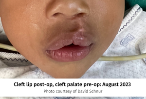 Cleft-lip-palate.png