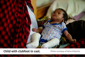 Clubfoot-(1).png