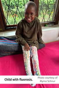 Fluorosis.png Fluorosis.png