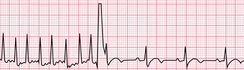 ECG-AF-Cardiovert-to-NSR_NEW.jpg