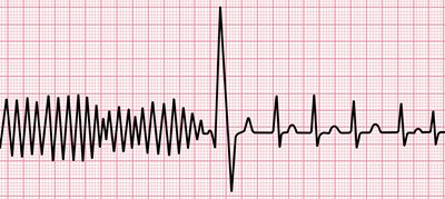 ECG-Vfib-defib-to-NSR_v1_original-(1).jpg