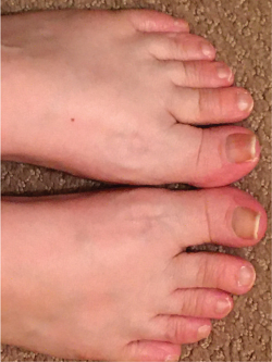 Featured image of post Covid Toe Images / Over the course of several days, the redness.