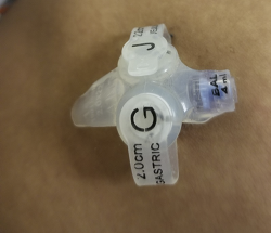 Nursing Care And Management Of Gastrostomy And Gastojejunostomy Tubes In The Pediatric Population Ce Article Nursingcenter