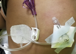 Nursing Care And Management Of Gastrostomy And Gastojejunostomy Tubes In The Pediatric Population Ce Article Nursingcenter
