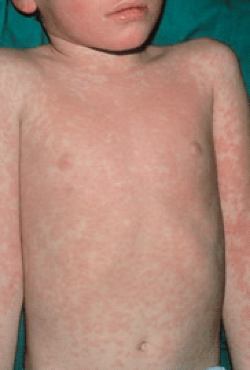 Figure. Measles... - Click to enlarge in new window